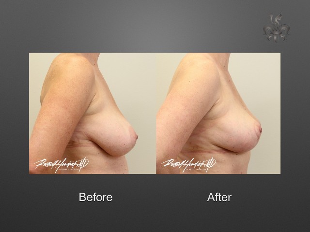 breast lift before and after