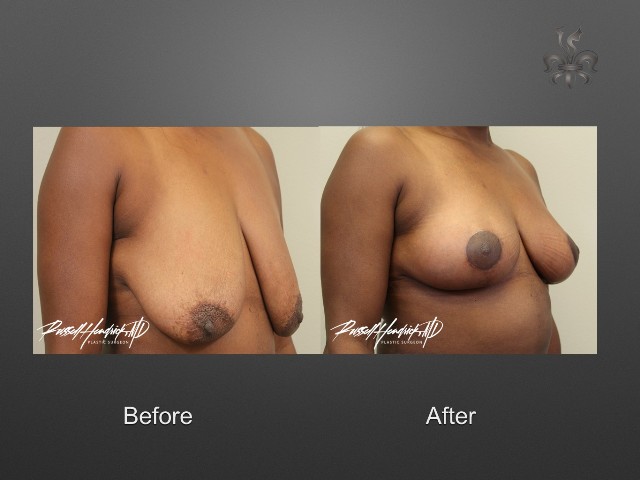 breast lift before and after