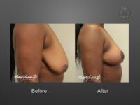 breast lift before and after