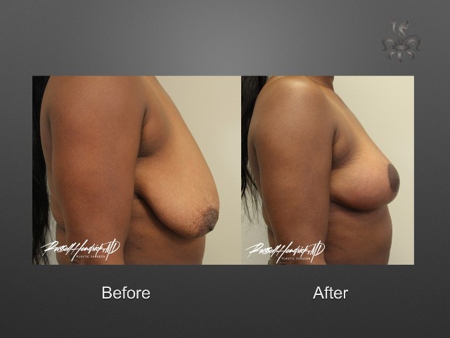 breast lift before and after