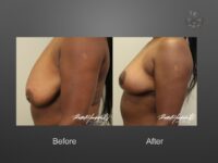 breast lift before and after