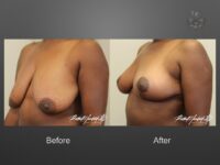 breast lift before and after