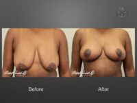 breast lift before and after