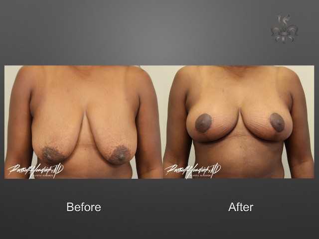 breast lift before and after