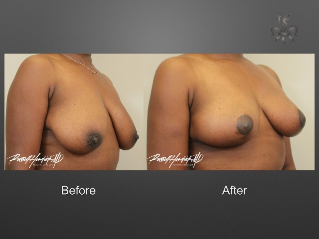 breast lift before and after