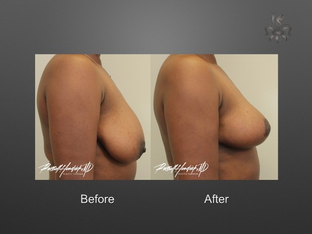 breast lift before and after