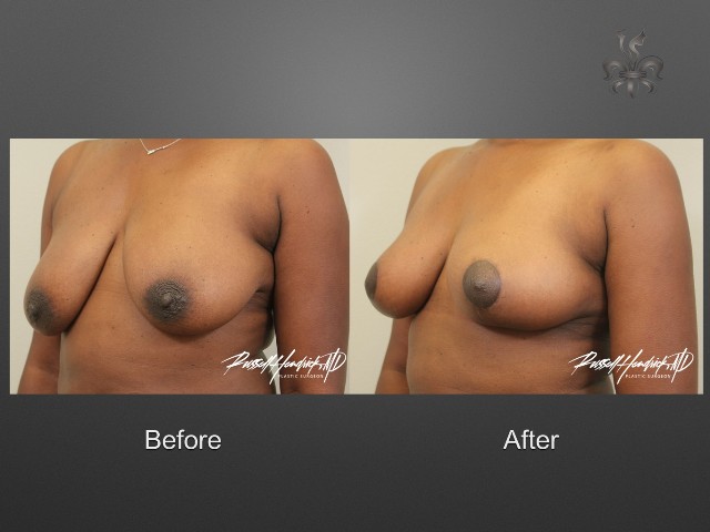 breast lift before and after