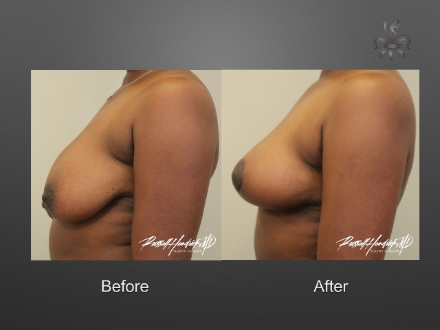 breast lift before and after