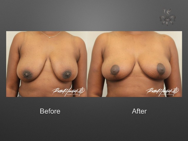 breast lift before and after
