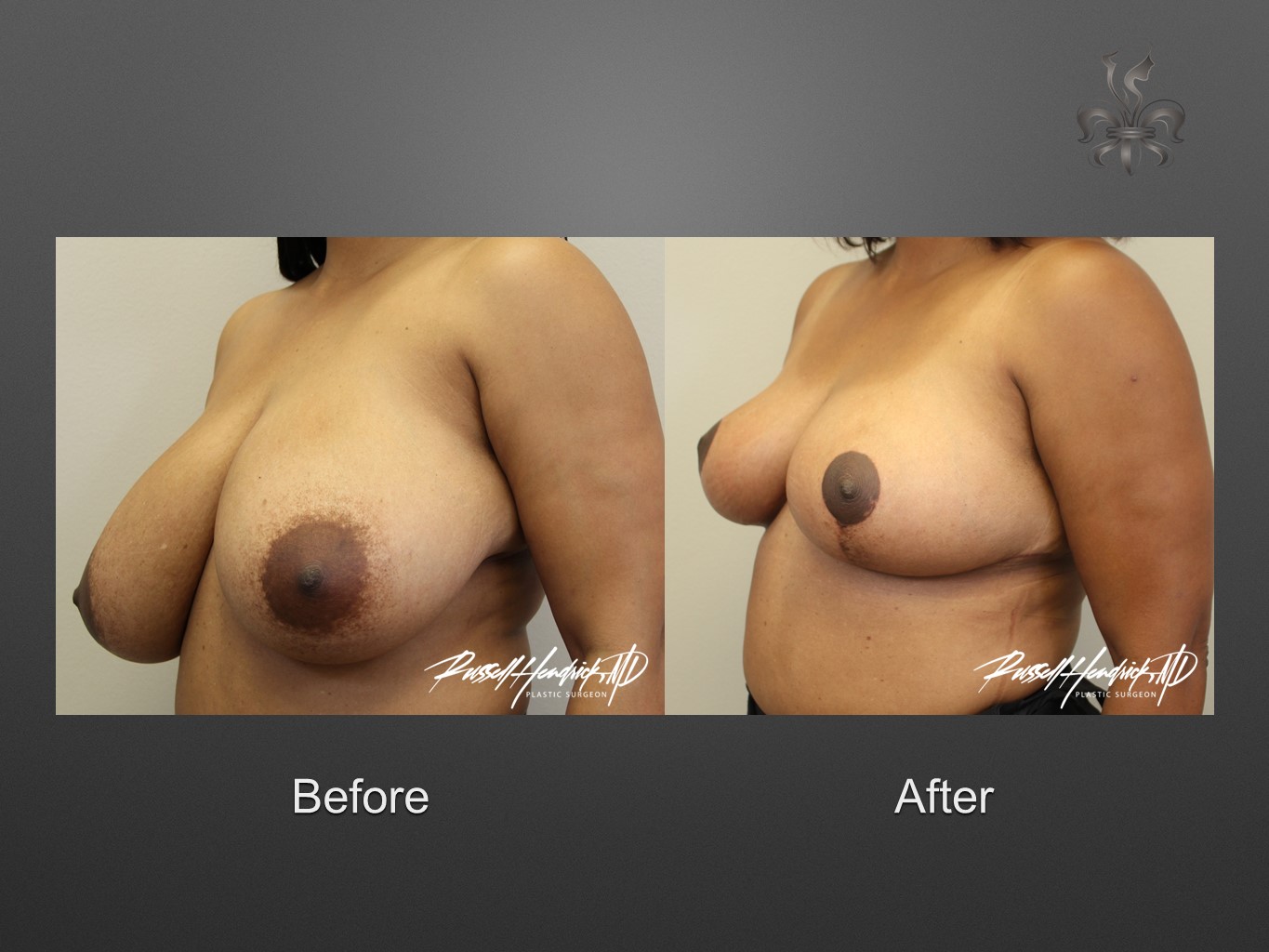 breast reduction before and after