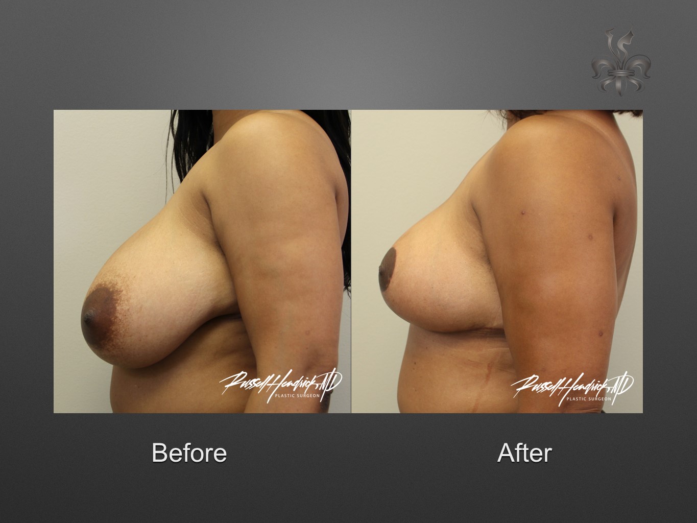 breast reduction before and after
