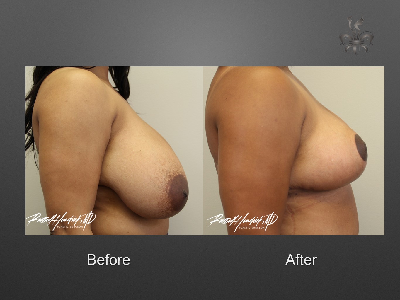 breast reduction before and after