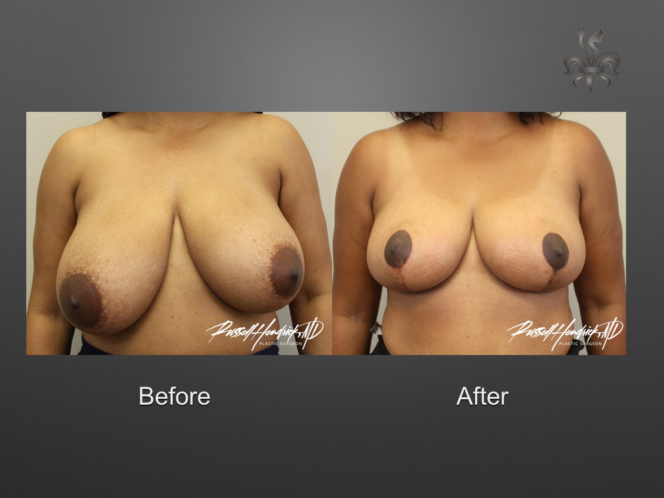 breast reduction before and after