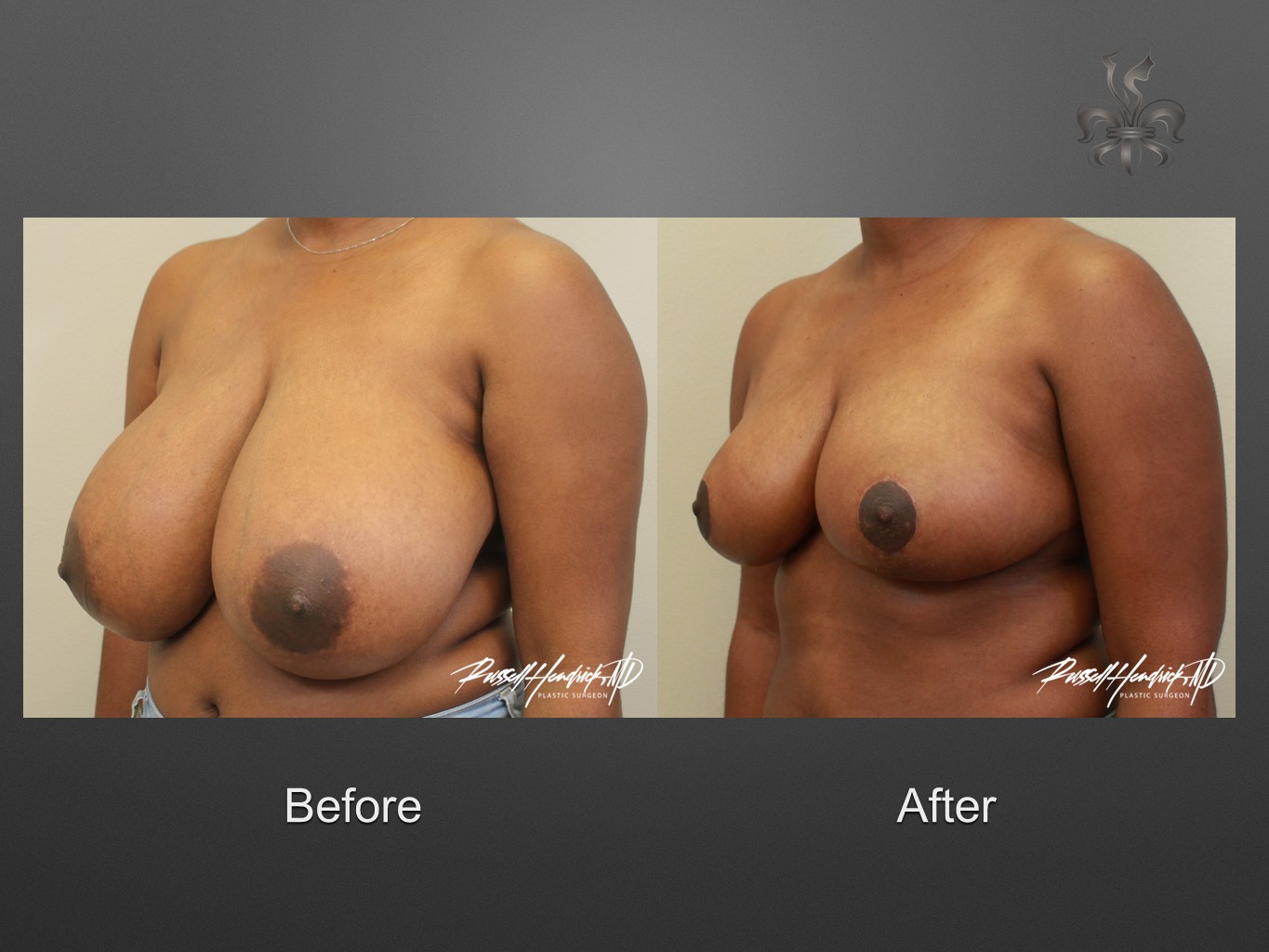 breast reduction before and after