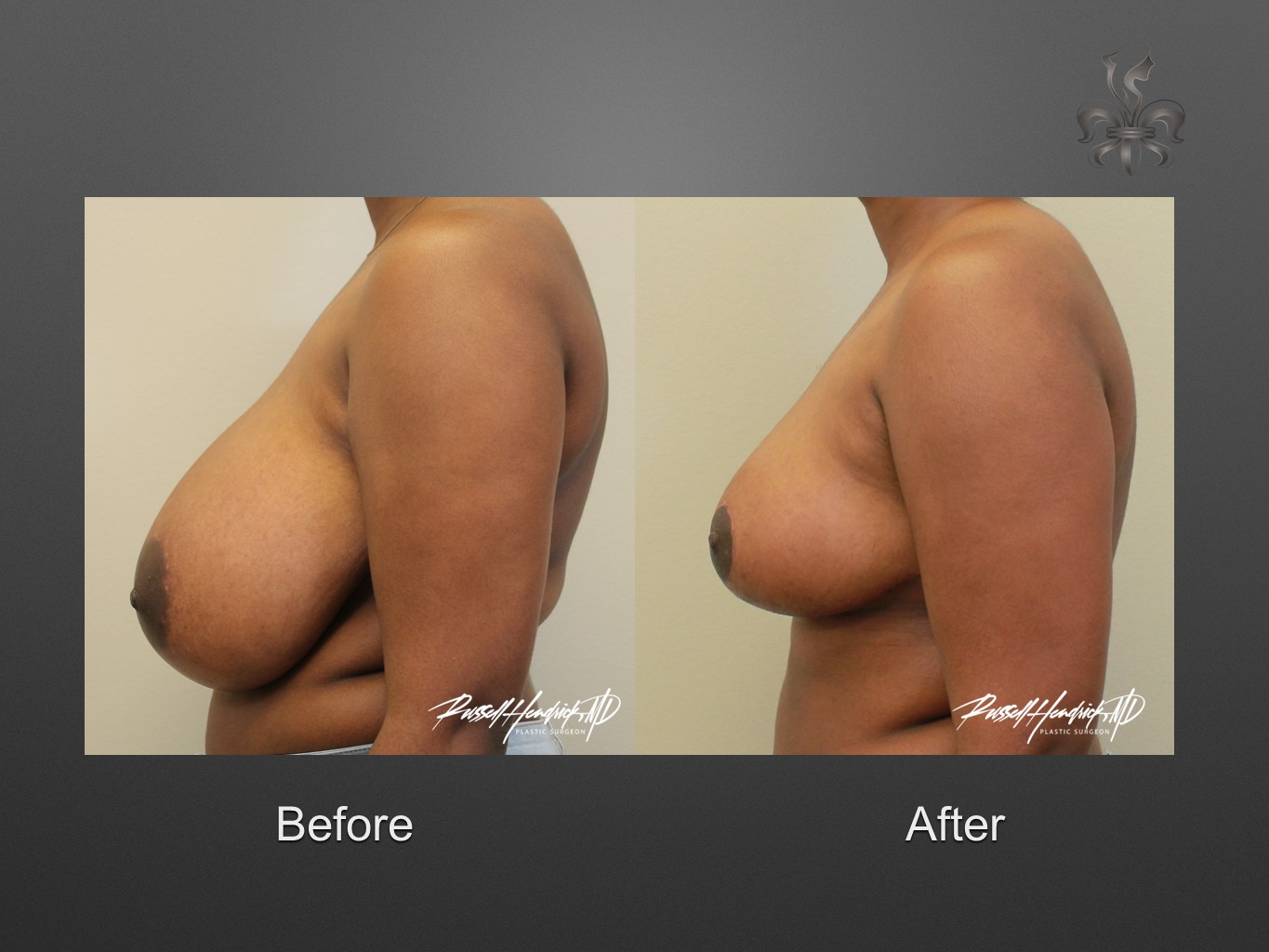 breast reduction before and after