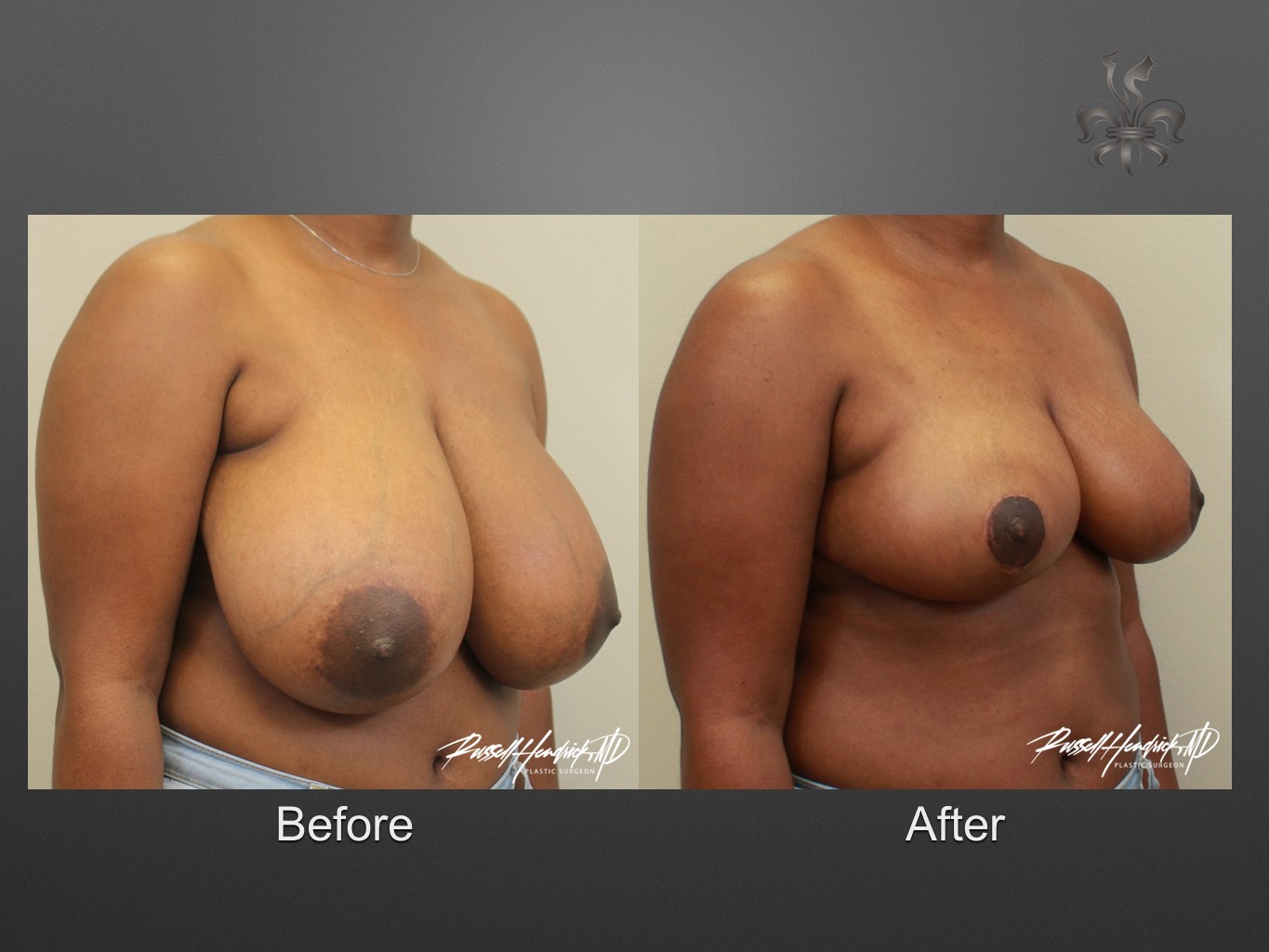 breast reduction before and after