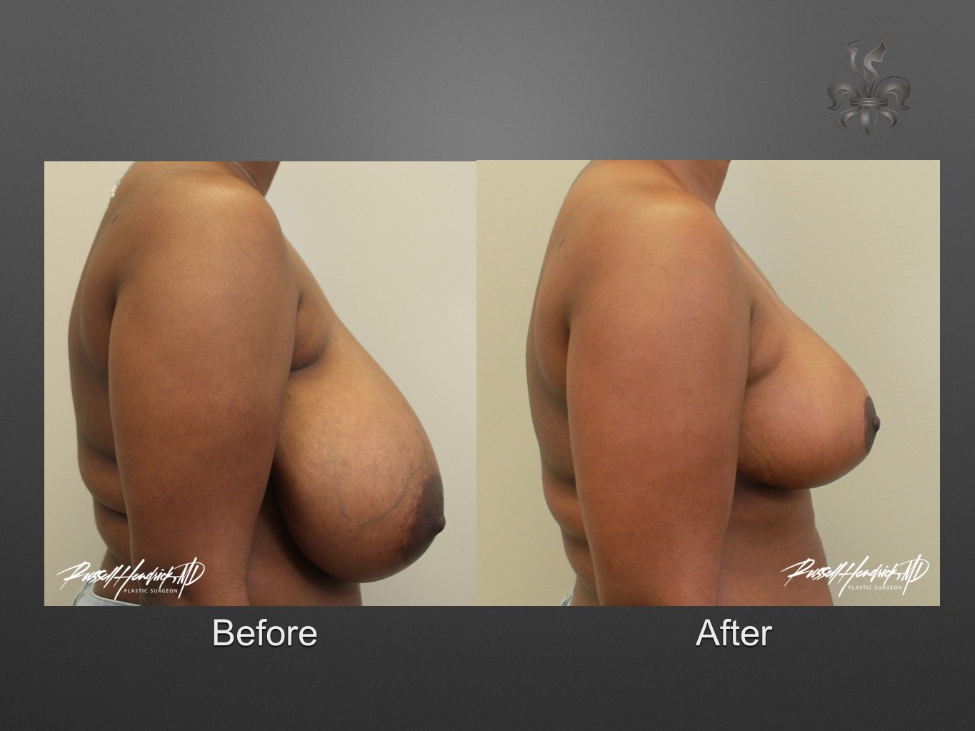 breast reduction before and after