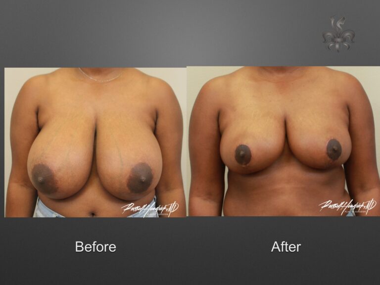breast reduction before and after