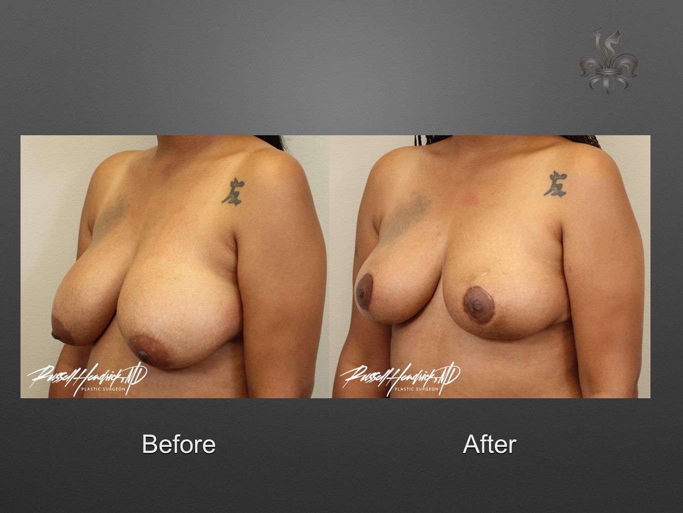 breast reduction before and after