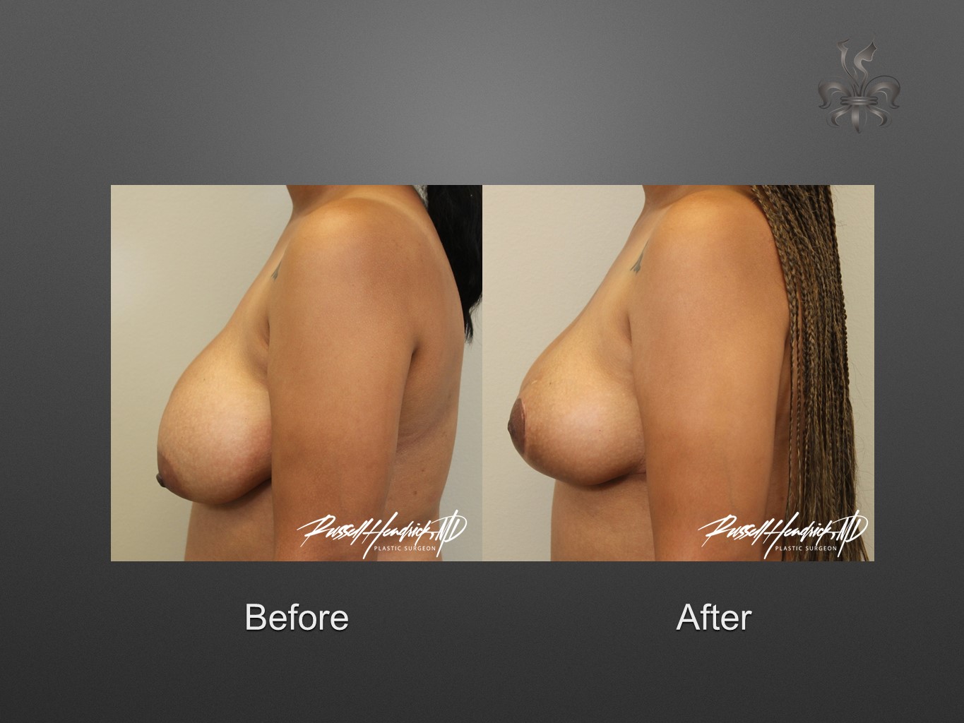 breast reduction before and after
