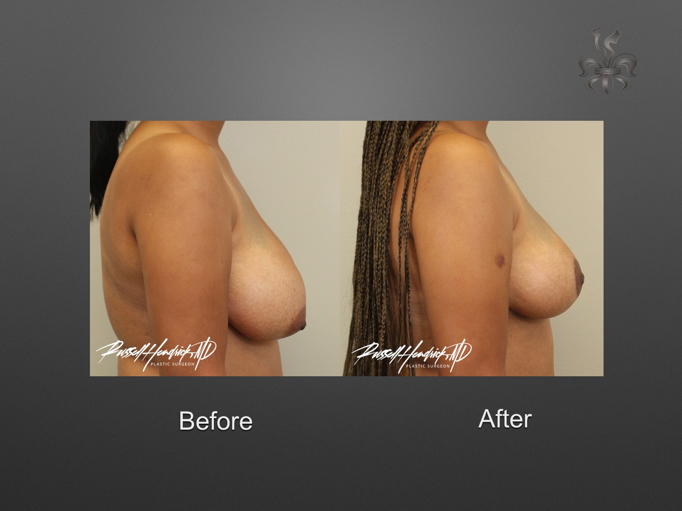 breast reduction before and after
