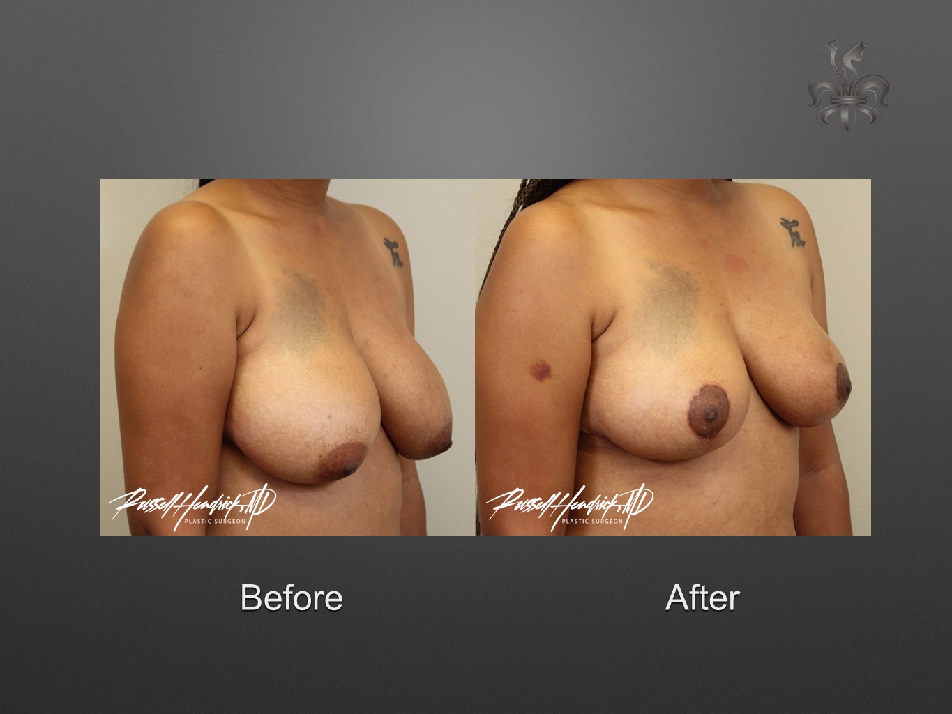 breast reduction before and after