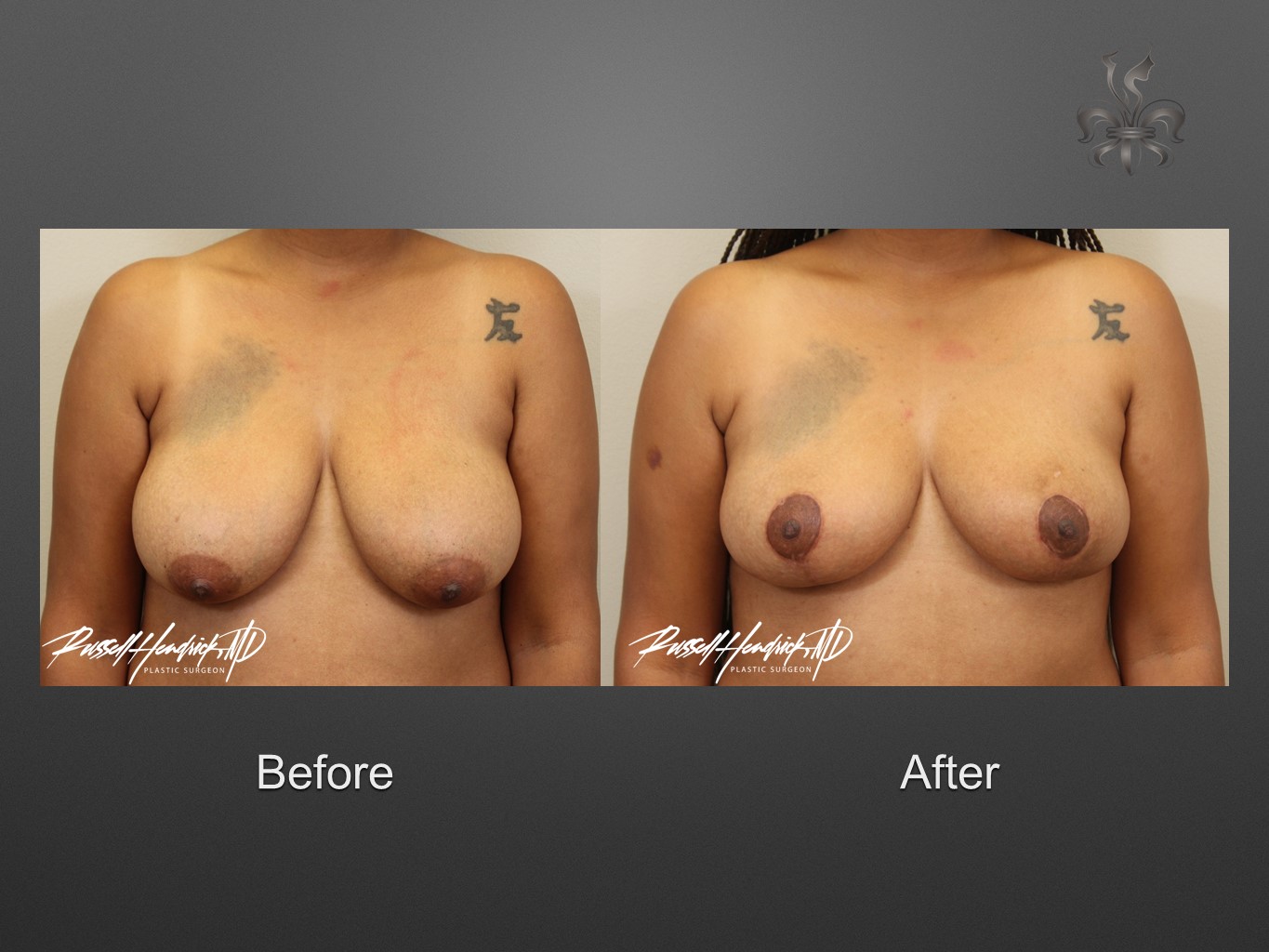breast reduction before and after