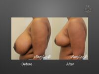 breast reduction before and after