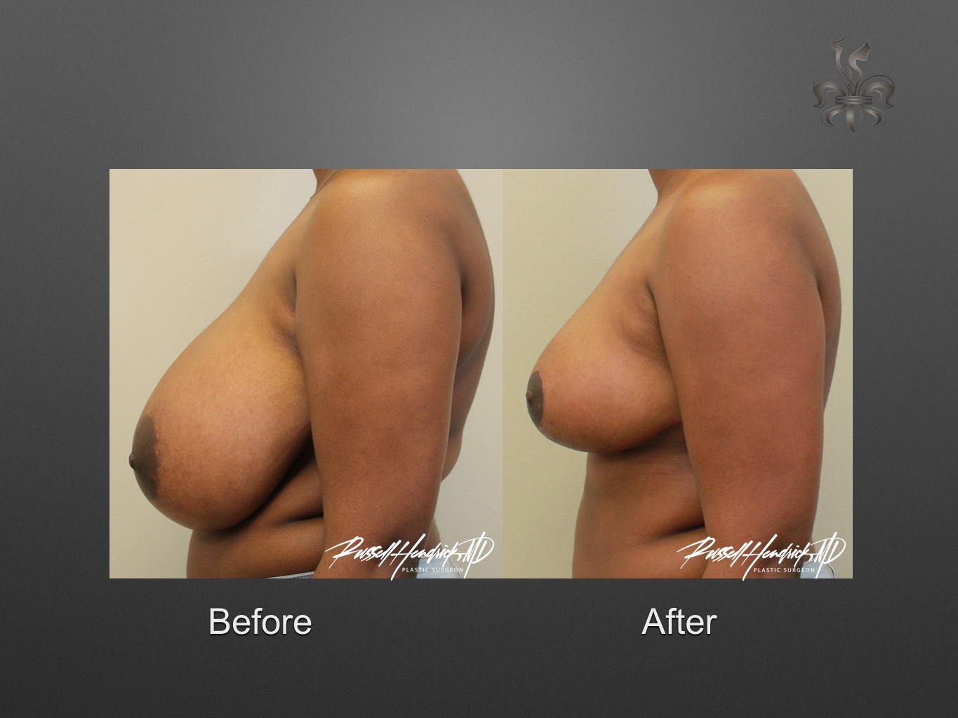 breast reduction before and after