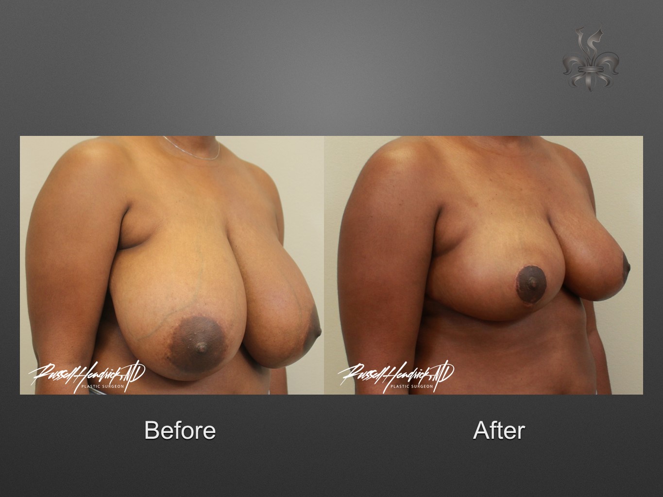 breast reduction before and after