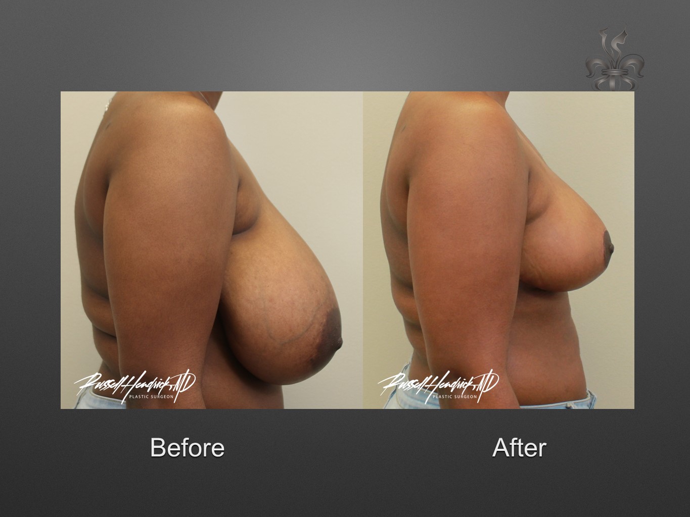 breast reduction before and after