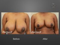 breast reduction before and after