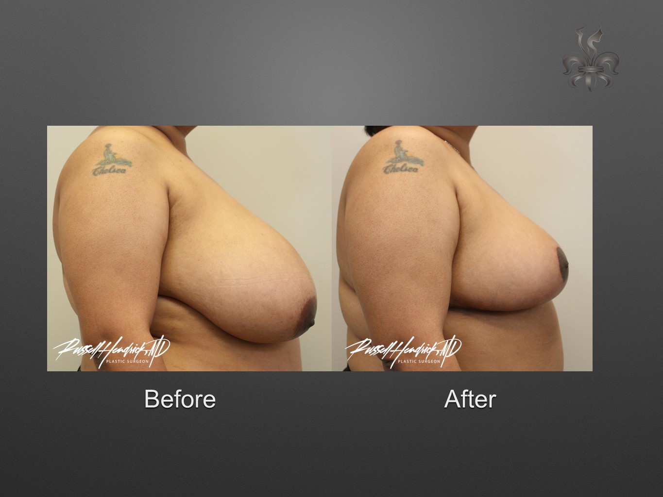 breast reduction before and after