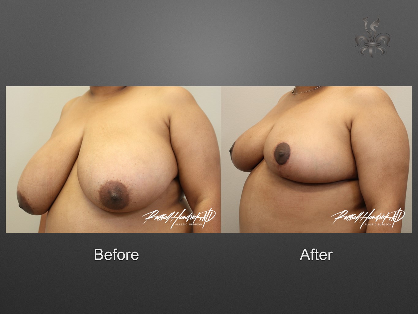 breast reduction before and after