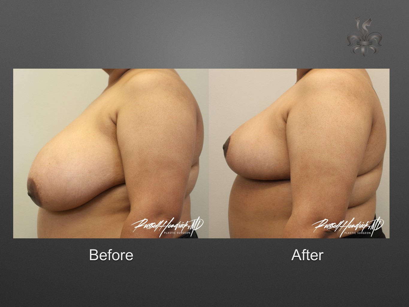 breast reduction before and after