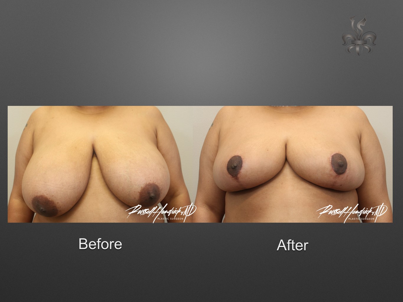 breast reduction before and after