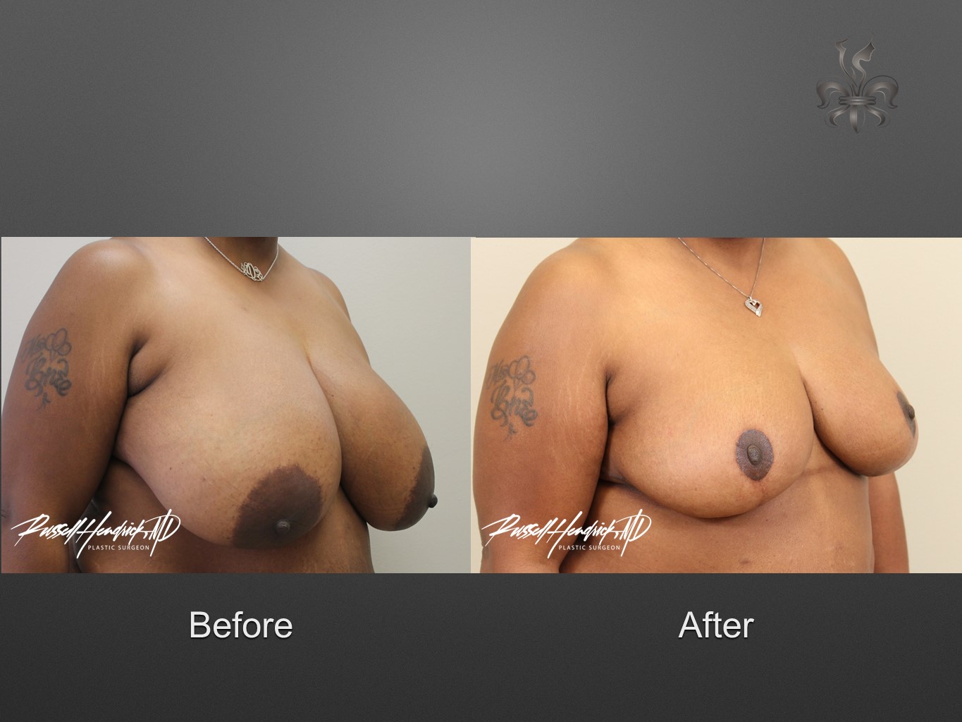 breast reduction before and after