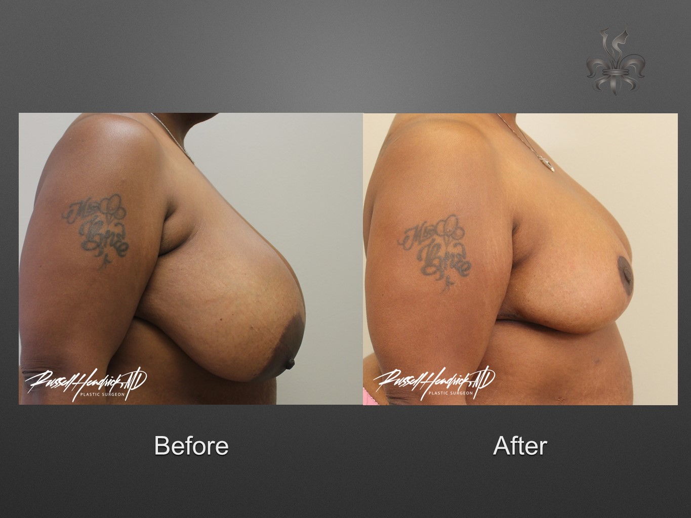 breast reduction before and after