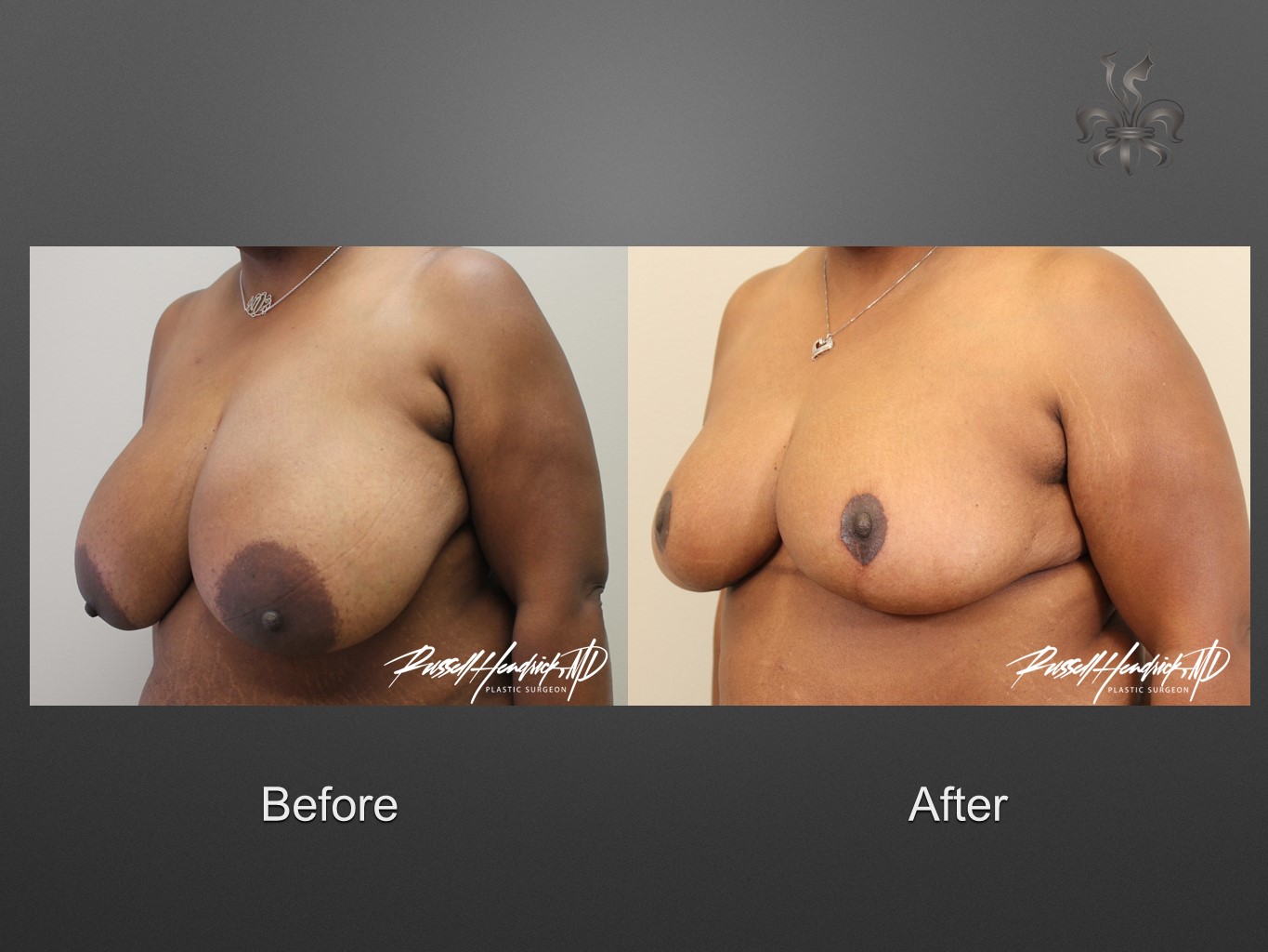 breast reduction before and after
