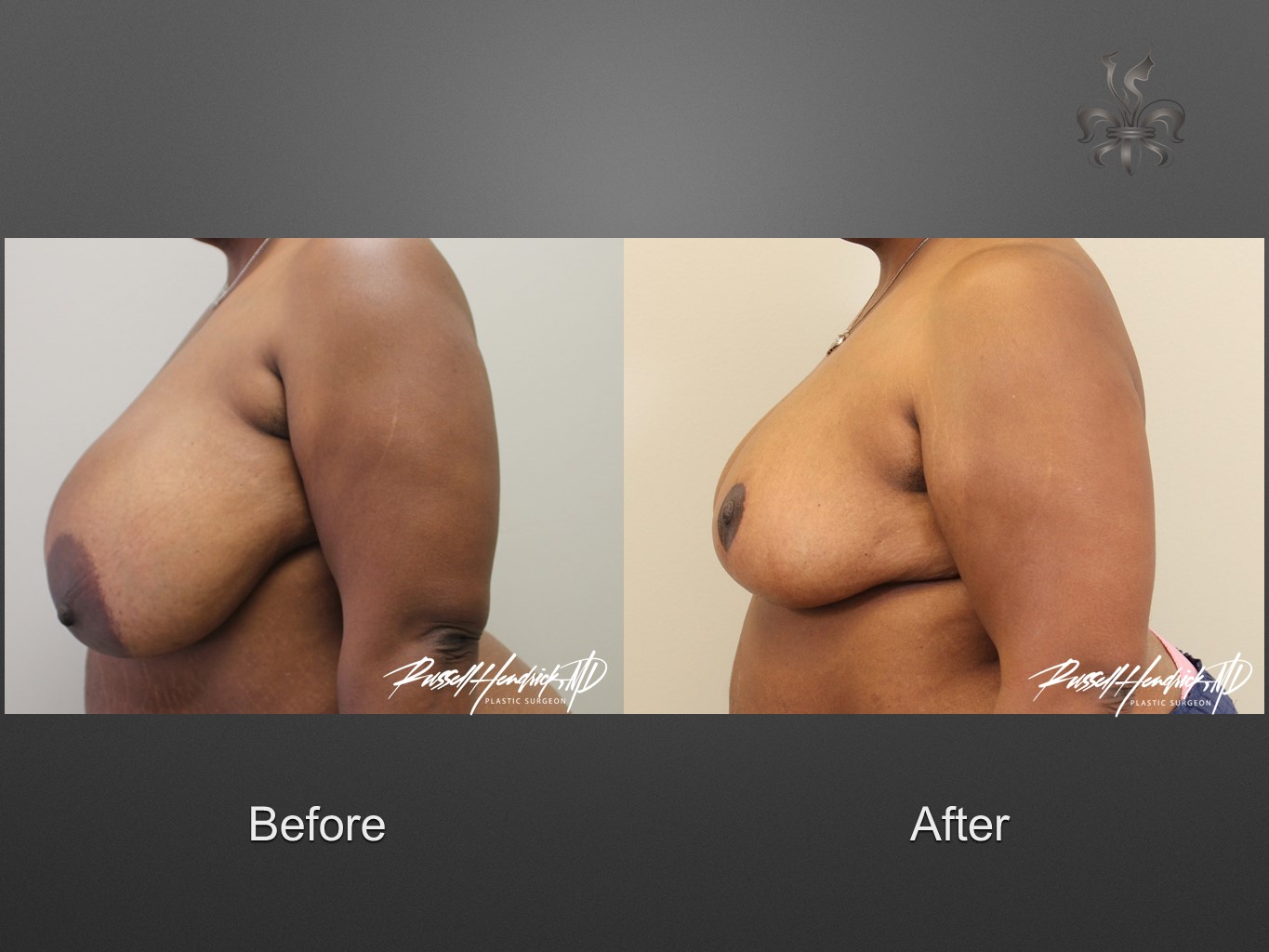 breast reduction before and after