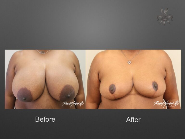 breast reduction before and after