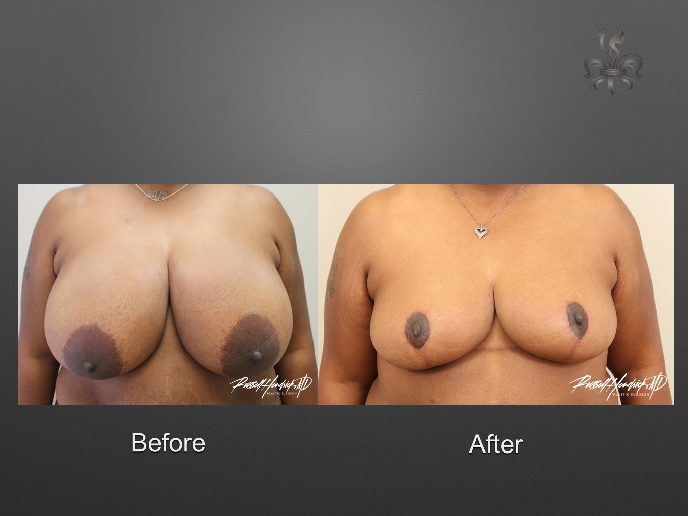 breast reduction before and after