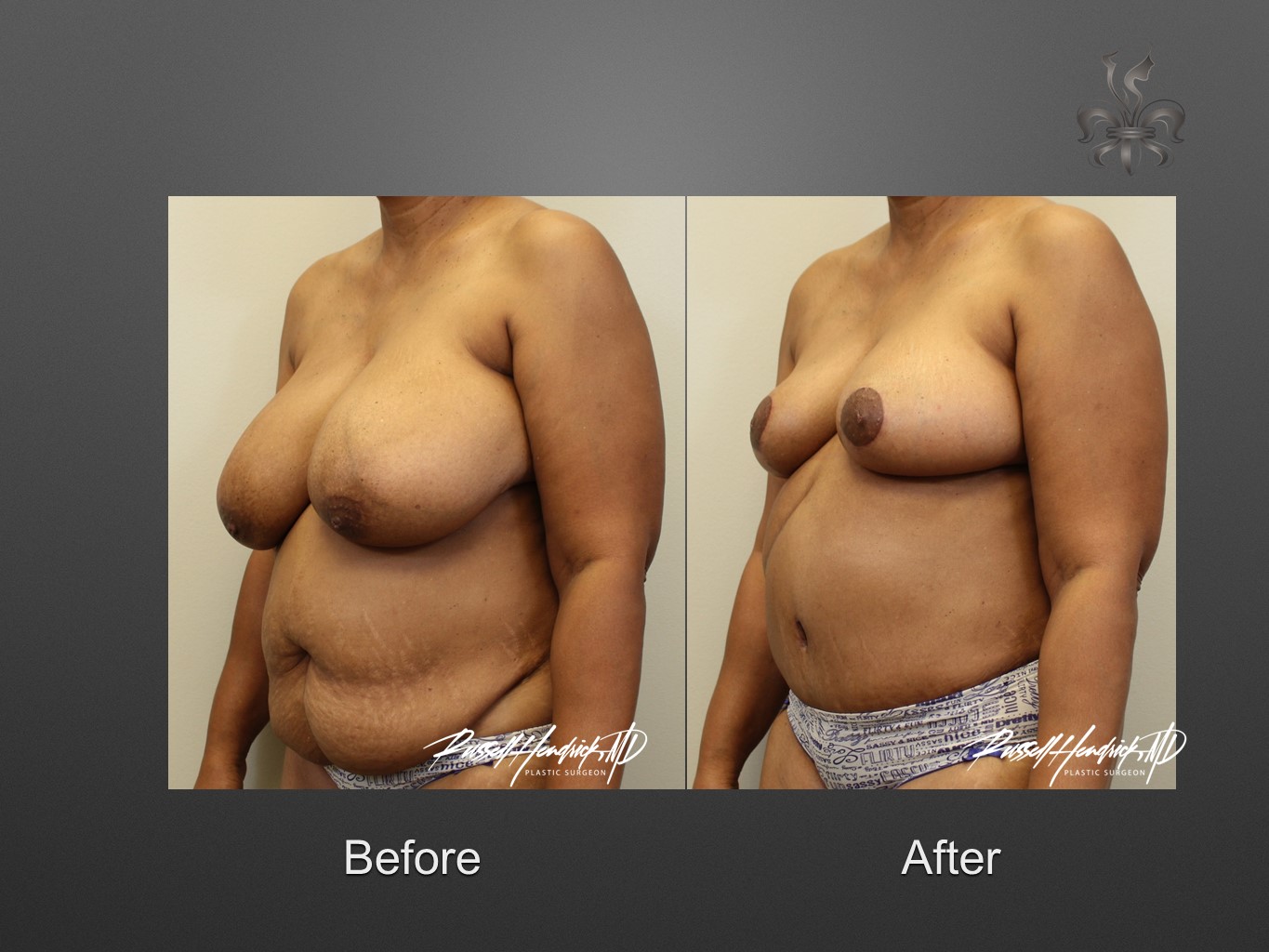 breast reduction before and after
