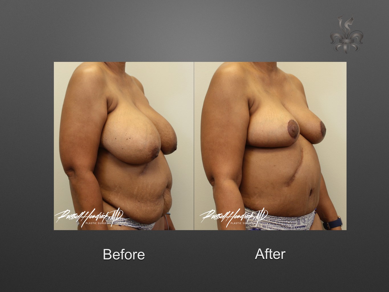 breast reduction before and after