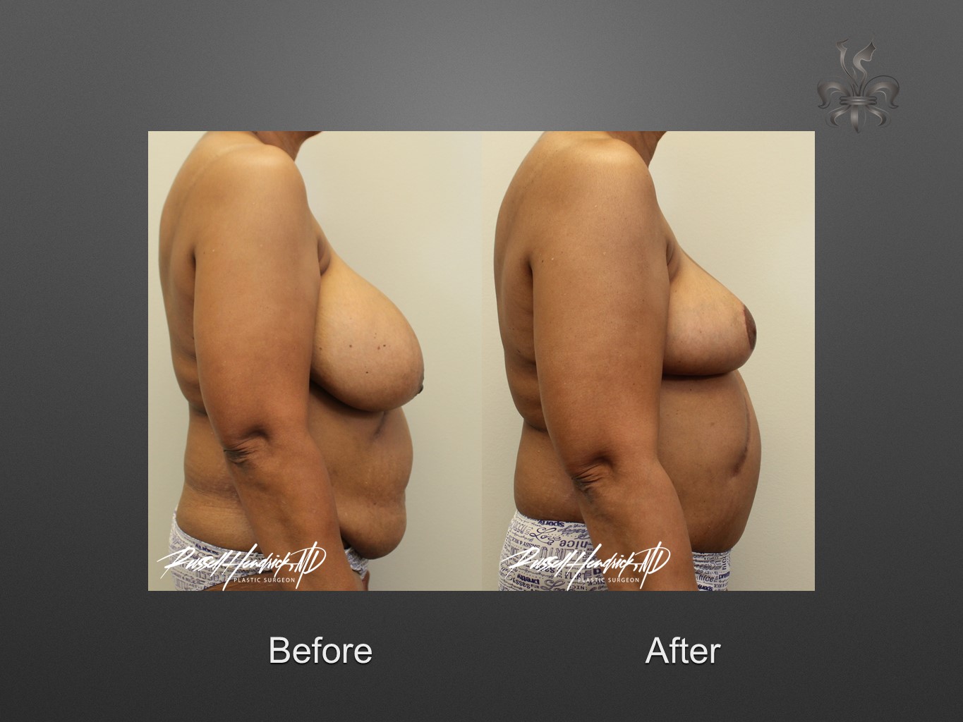 breast reduction before and after