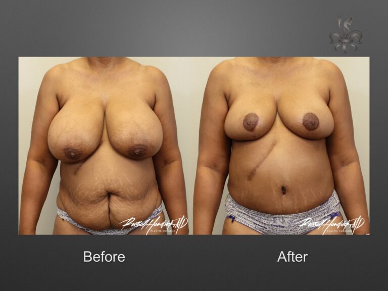 breast reduction before and after