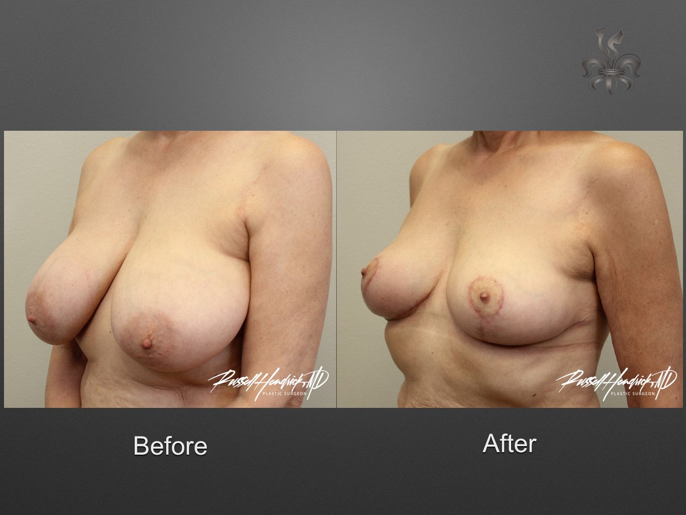 breast reduction before and after