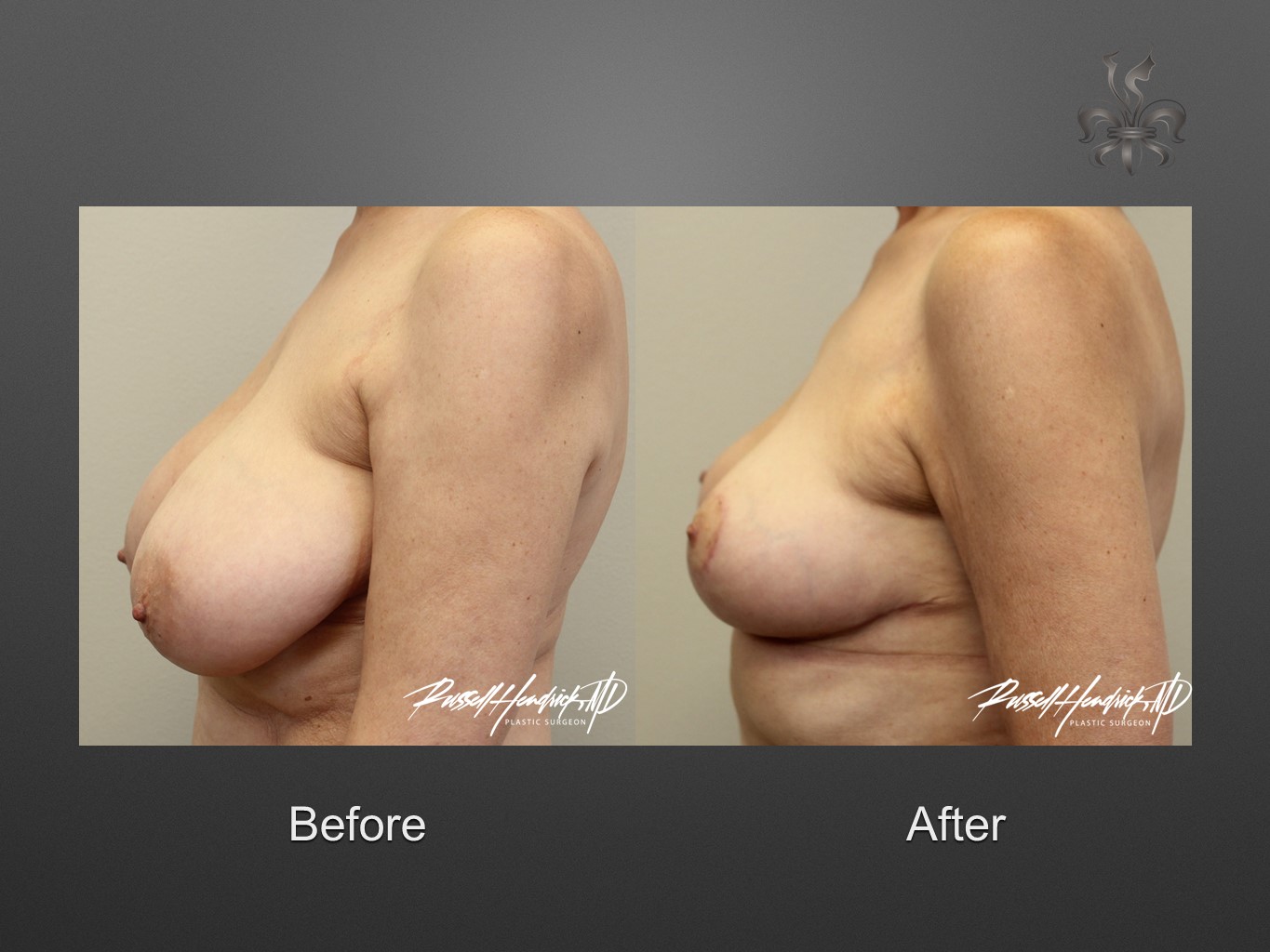 breast reduction before and after