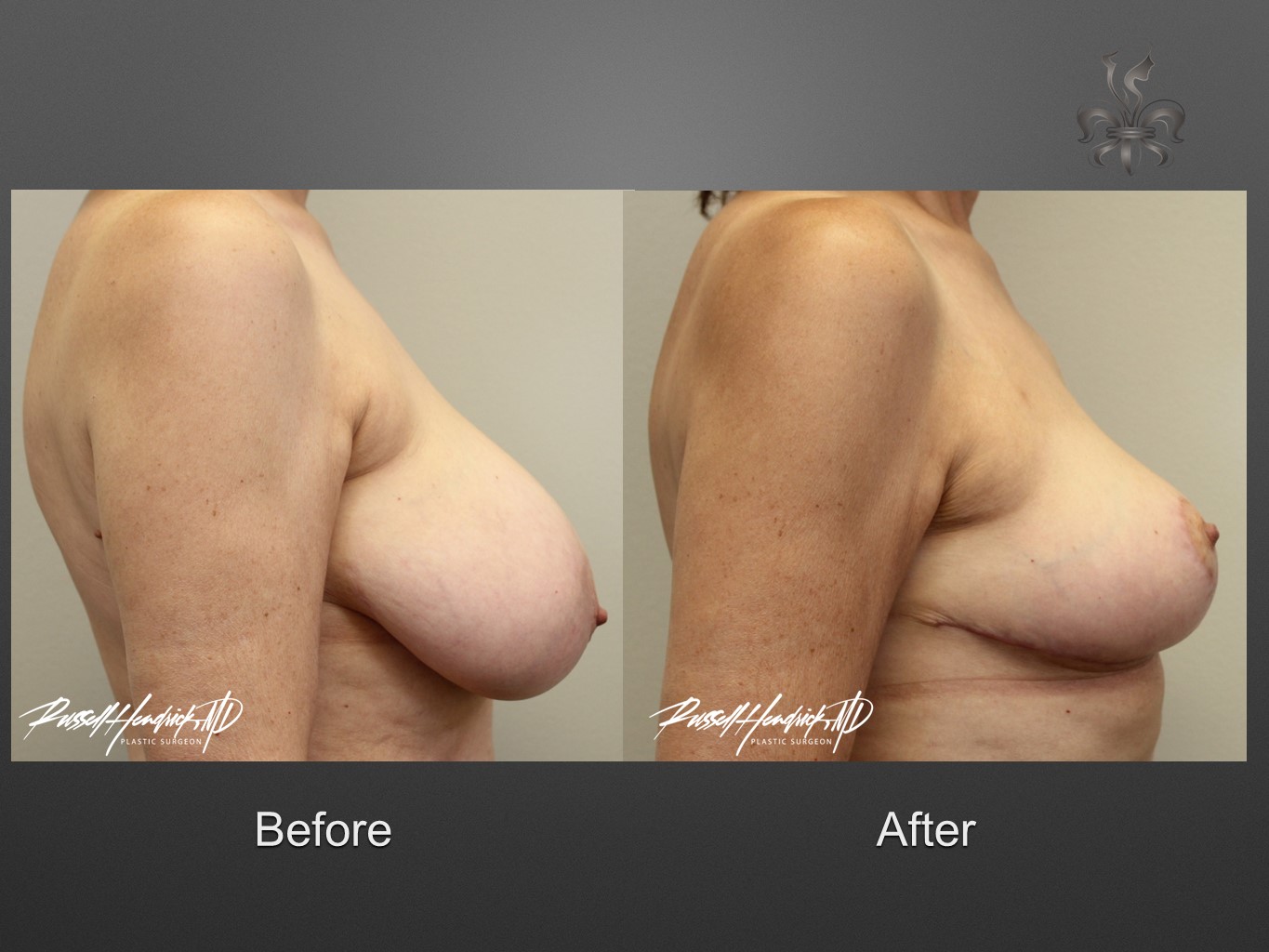 breast reduction before and after