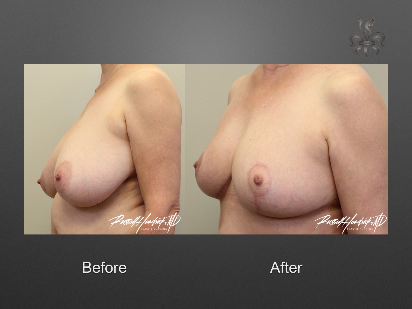 breast reduction before and after
